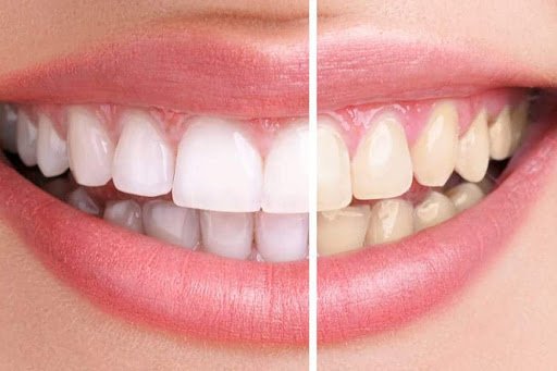 Blanchir ses dents et enlever le tartre en 2 minutes avec le girofle et le laurier : info, mythe et alternative sûre